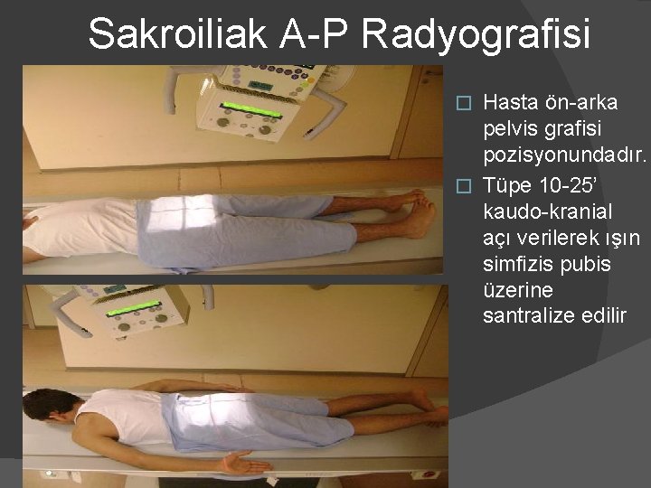 Sakroiliak A-P Radyografisi Hasta ön-arka pelvis grafisi pozisyonundadır. � Tüpe 10 -25’ kaudo-kranial açı