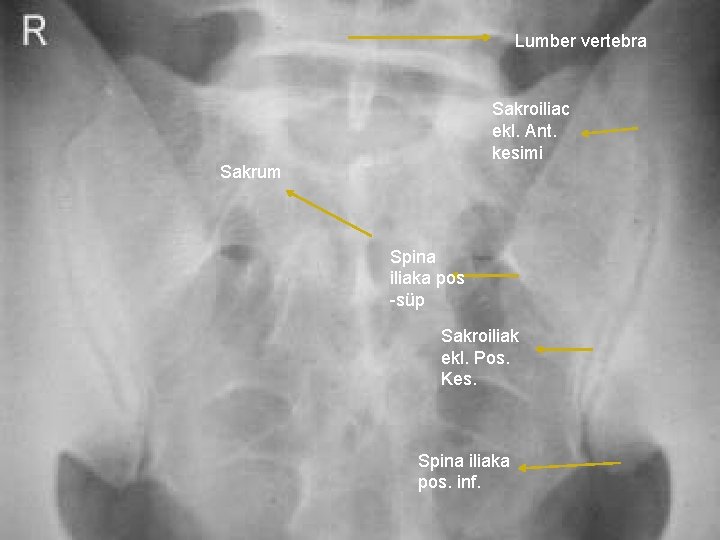 Lumber vertebra Sakroiliac ekl. Ant. kesimi Sakrum Spina iliaka pos -süp Sakroiliak ekl. Pos.