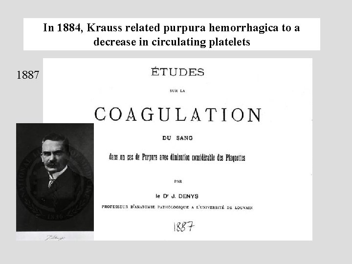 In 1884, Krauss related purpura hemorrhagica to a decrease in circulating platelets 1887 