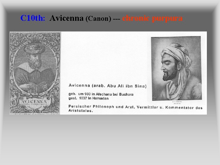 C 10 th: Avicenna (Canon) --- chronic purpura 