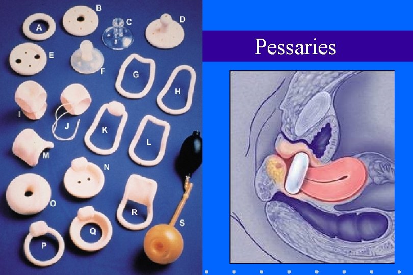 Pessaries Pessaries