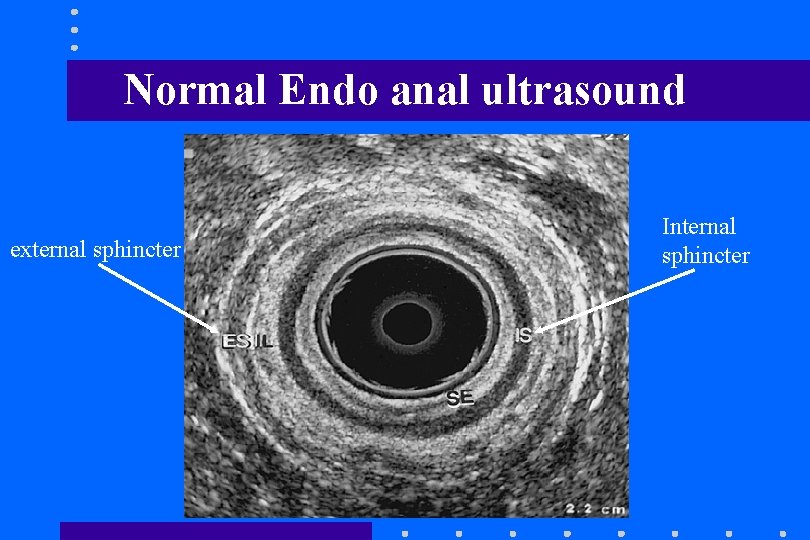 Normal Endo anal ultrasound external sphincter Internal sphincter Normal Endo anal ultrasound external sphincter Internal sphincter
