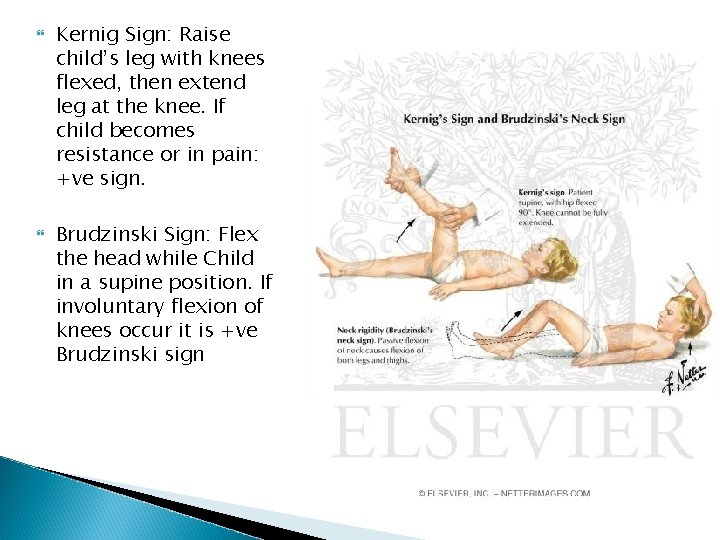  Kernig Sign: Raise child’s leg with knees flexed, then extend leg at the