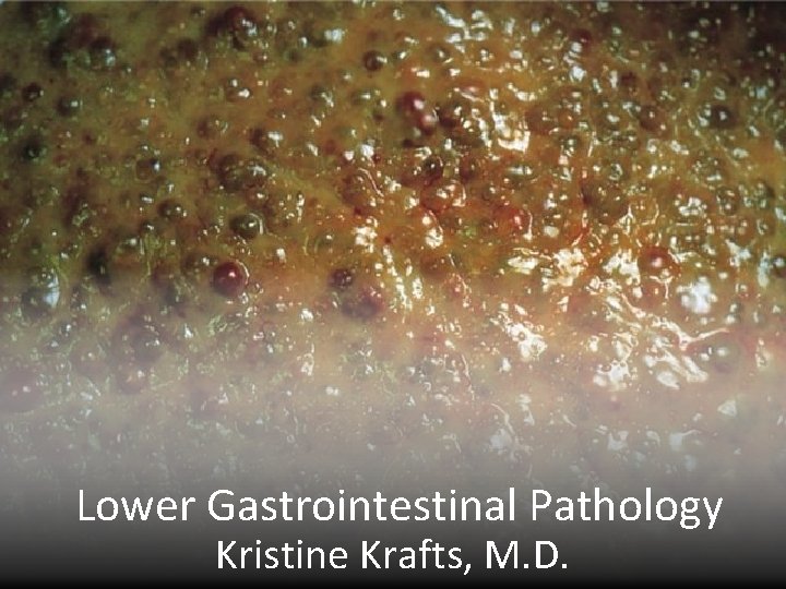 Lower Gastrointestinal Pathology Kristine Krafts, M. D. 