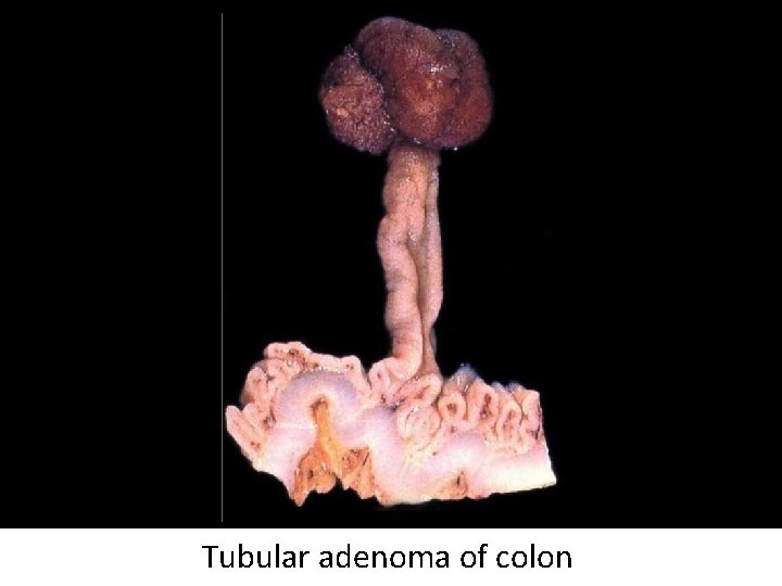 Tubular adenoma of colon 