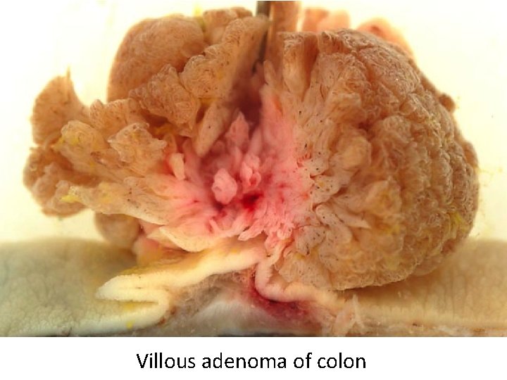 Villous adenoma of colon 