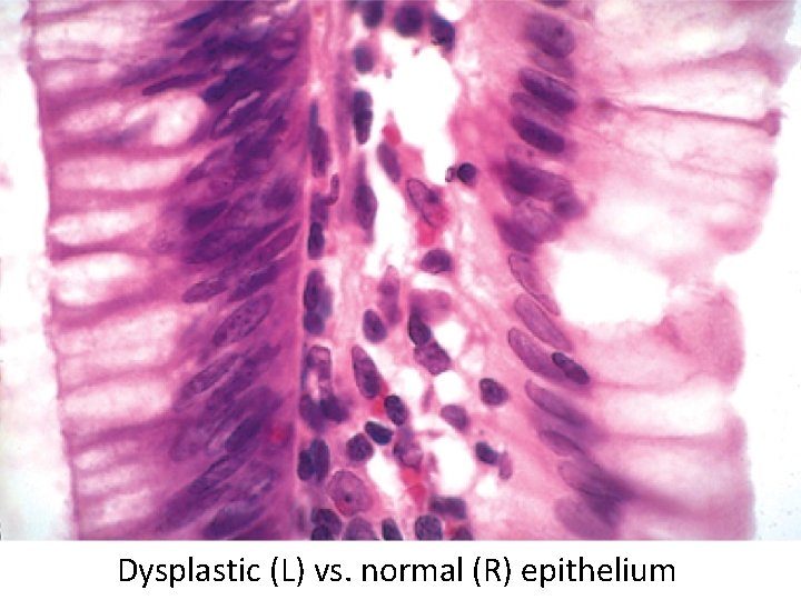 Dysplastic (L) vs. normal (R) epithelium 