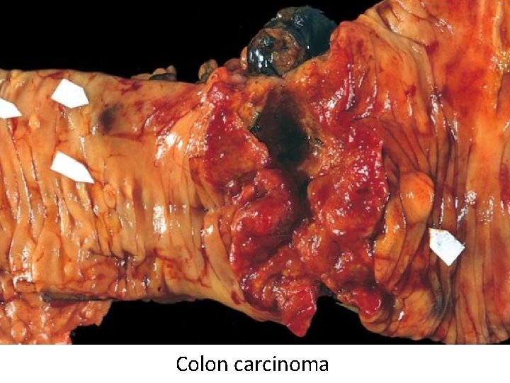Colon carcinoma 
