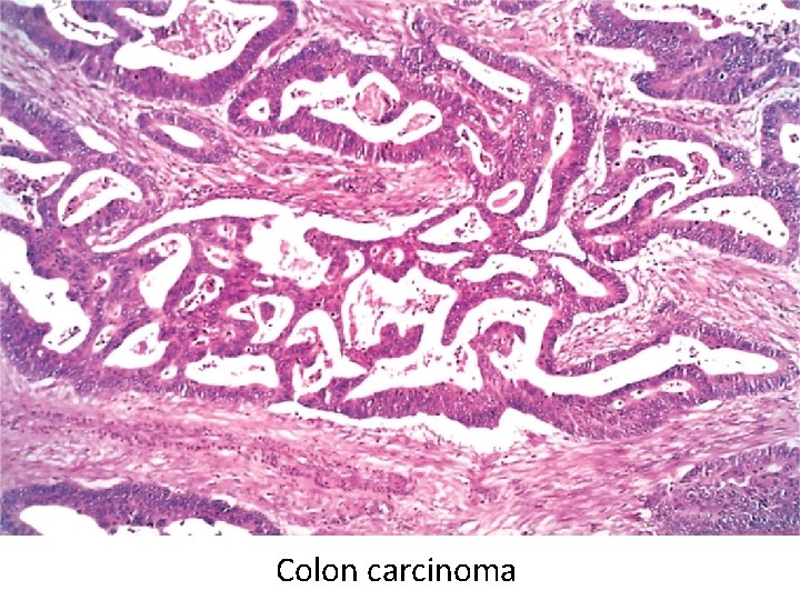 Colon carcinoma 