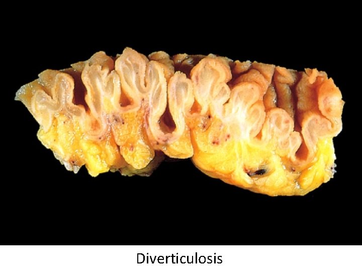 Diverticulosis 
