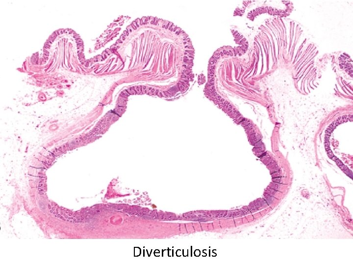 Diverticulosis 