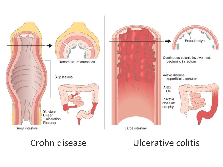 Crohn disease Ulcerative colitis 