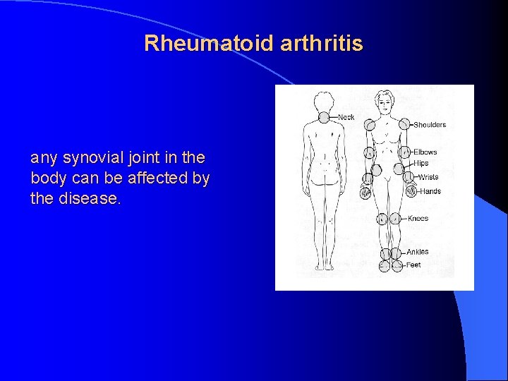 Rheumatoid arthritis any synovial joint in the body can be affected by the disease.