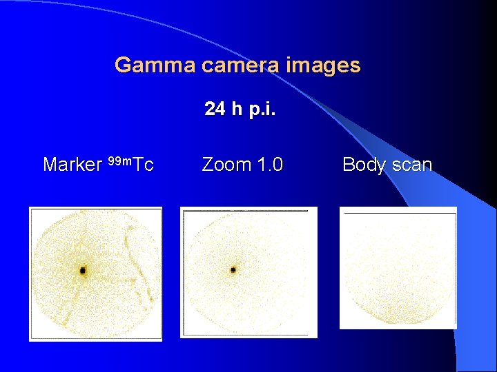 Gamma camera images 24 h p. i Marker 99 m. Tc Zoom 1. 0