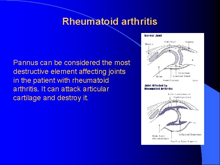 Rheumatoid arthritis Pannus can be considered the most destructive element affecting joints in the