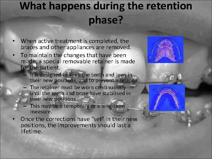 What happens during the retention phase? • When active treatment is completed, the braces What happens during the retention phase? • When active treatment is completed, the braces