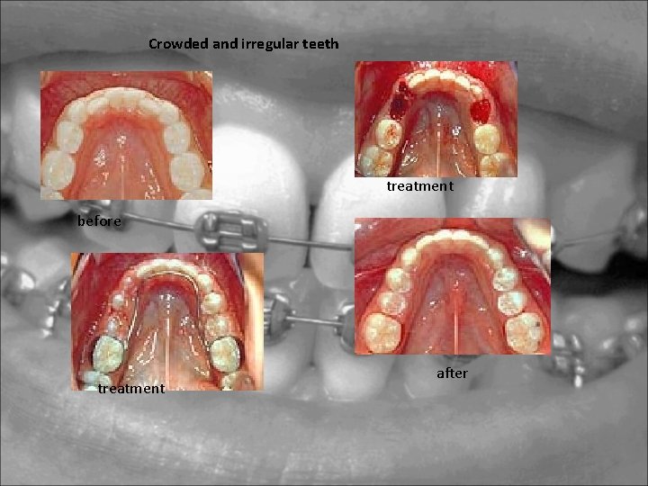 Crowded and irregular teeth treatment before treatment after Crowded and irregular teeth treatment before treatment after