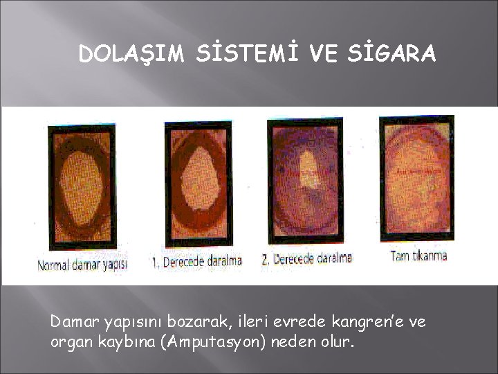 DOLAŞIM SİSTEMİ VE SİGARA Damar yapısını bozarak, ileri evrede kangren’e ve organ kaybına (Amputasyon)