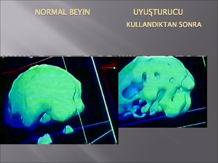 NORMAL BEYİN UYUŞTURUCU KULLANDIKTAN SONRA 