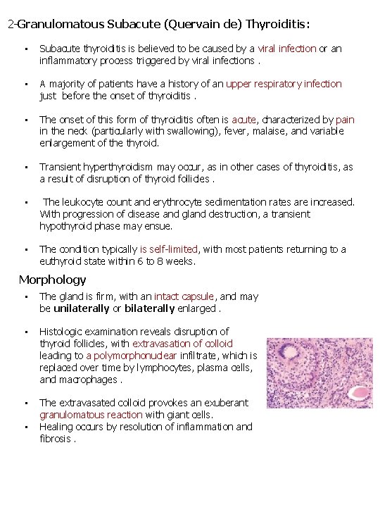 2 -Granulomatous Subacute (Quervain de) Thyroiditis: • Subacute thyroiditis is believed to be 2 -Granulomatous Subacute (Quervain de) Thyroiditis: • Subacute thyroiditis is believed to be