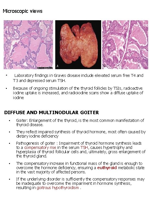 Microscopic views • Laboratory findings in Graves disease include elevated serum free T 4 Microscopic views • Laboratory findings in Graves disease include elevated serum free T 4