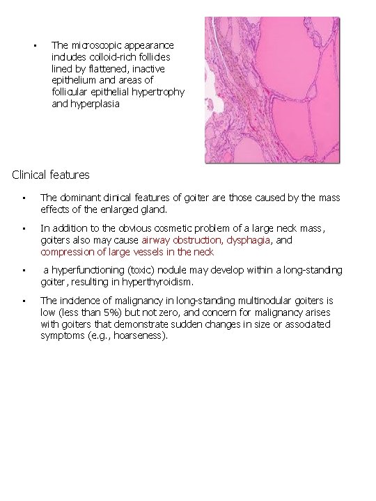  • The microscopic appearance includes colloid-rich follicles lined by flattened, inactive epithelium and