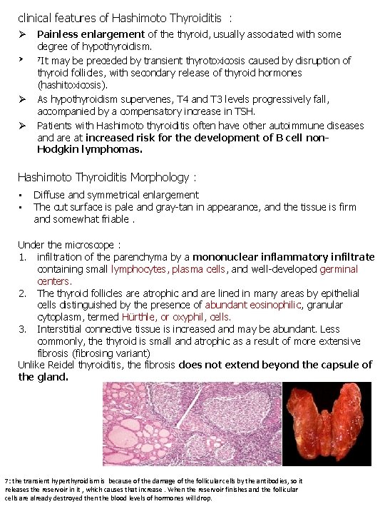 clinical features of Hashimoto Thyroiditis : Ø Ø Painless enlargement of the thyroid, usually clinical features of Hashimoto Thyroiditis : Ø Ø Painless enlargement of the thyroid, usually