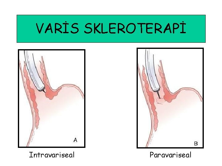 VARİS SKLEROTERAPİ Intravariseal Paravariseal 