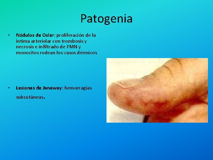 Patogenia • Nódulos de Osler: proliferación de la íntima arteriolar con trombosis y necrosis