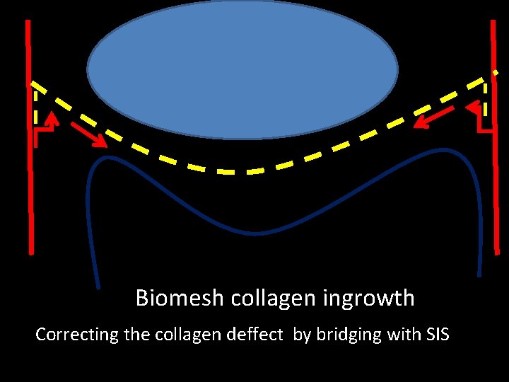 Biomesh collagen ingrowth Correcting the collagen deffect by bridging with SIS 