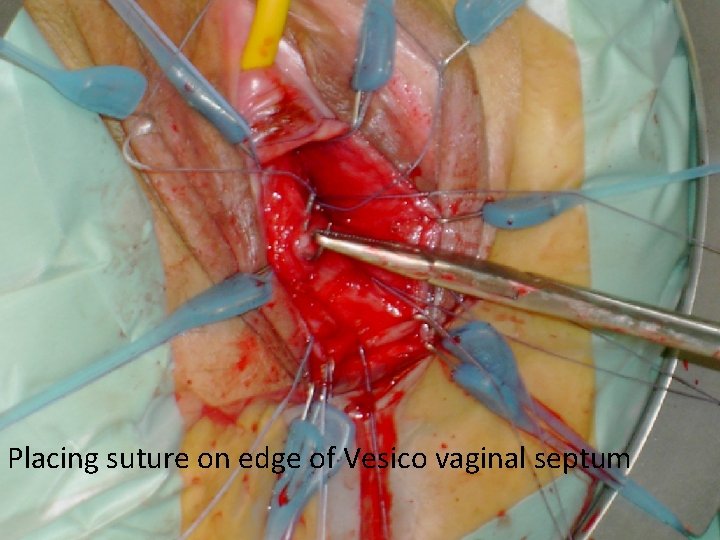 Placing suture on edge of Vesico vaginal septum 