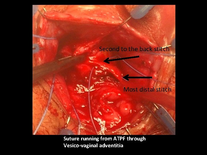 Second to the back stitch Most distal stitch Suture running from ATPF through Vesico-vaginal
