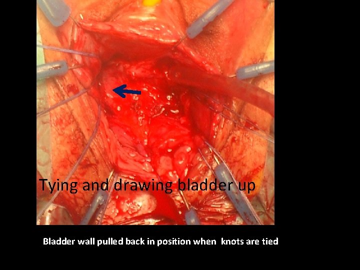 Tying and drawing bladder up Bladder wall pulled back in position when knots are