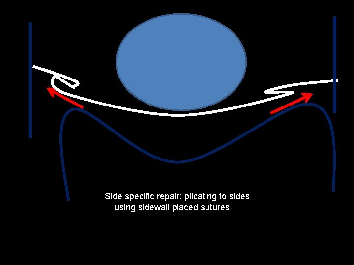 Side specific repair: plicating to sides using sidewall placed sutures 