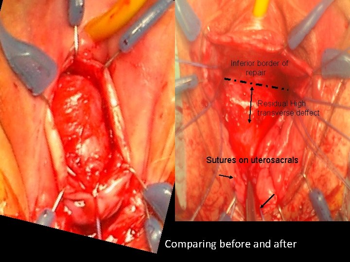 Inferior border of repair Residual High transverse deffect Sutures on uterosacrals Comparing before and