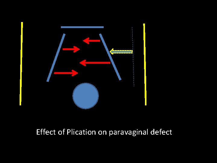 Effect of Plication on paravaginal defect 