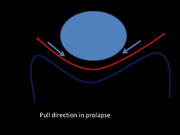Pull direction in prolapse 