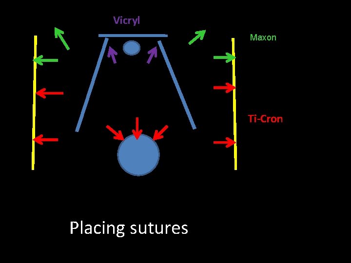 Vicryl Maxon Ti-Cron Placing sutures 