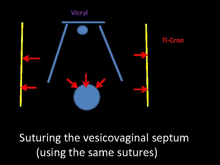 Vicryl Ti-Cron Suturing the vesicovaginal septum (using the same sutures) 