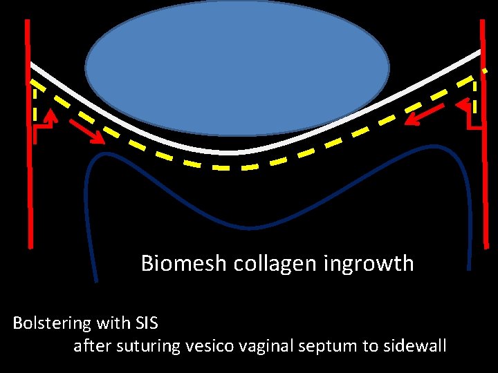 Biomesh collagen ingrowth Bolstering with SIS after suturing vesico vaginal septum to sidewall 