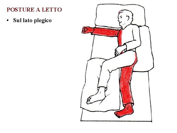 POSTURE A LETTO • Sul lato plegico 