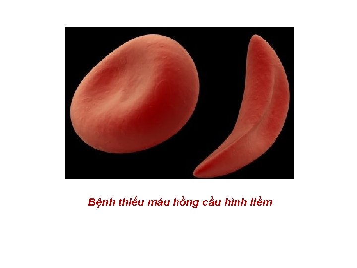 Bệnh thiếu máu hồng cầu hình liềm 