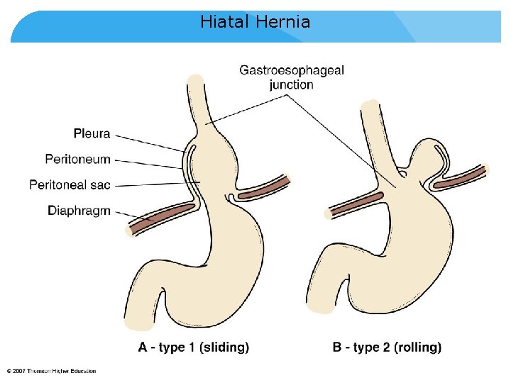 Hiatal Hernia © 2007 Thomson - Wadsworth 