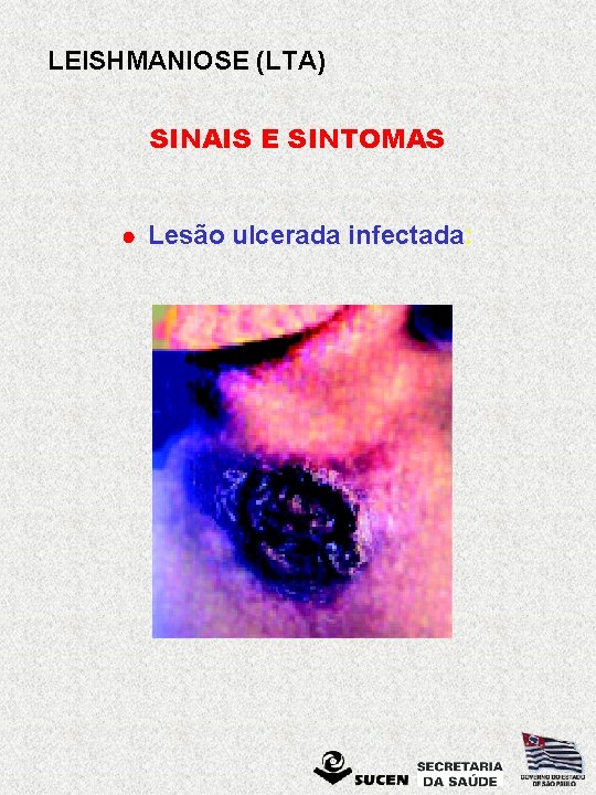 LEISHMANIOSE (LTA) SINAIS E SINTOMAS · Lesão ulcerada infectada: 