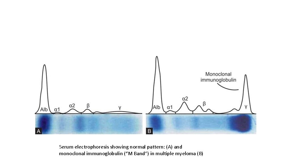 Serum electrophoresis showing normal pattern: (A) and monoclonal immunoglobulin (“M Band”) in multiple myeloma