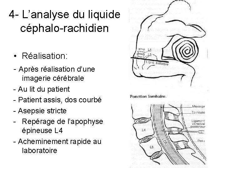 4 - L’analyse du liquide céphalo-rachidien • Réalisation: - Après réalisation d’une imagerie cérébrale