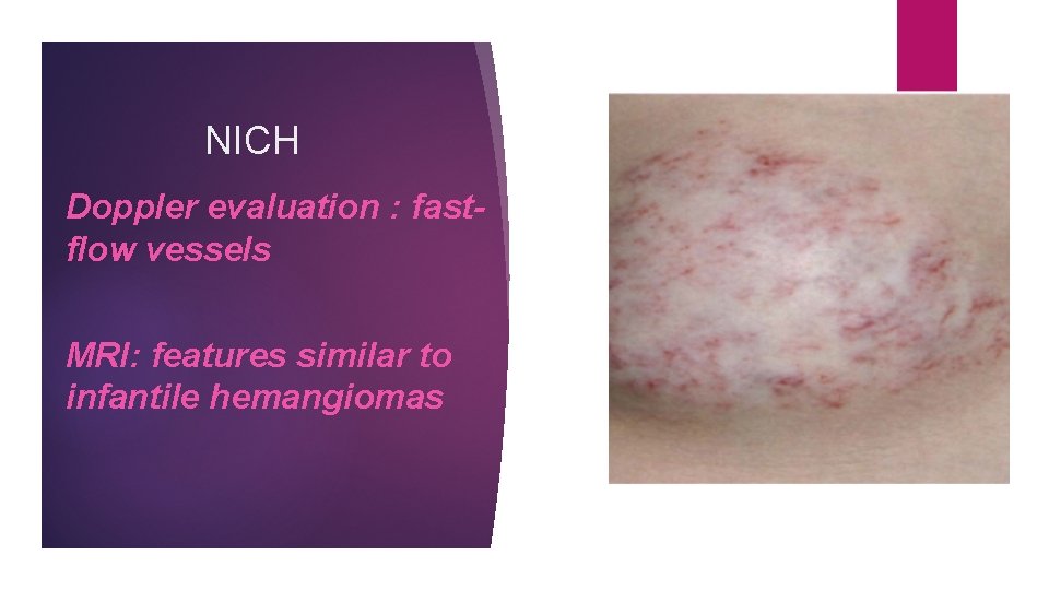 NICH Doppler evaluation : fastflow vessels MRI: features similar to infantile hemangiomas 