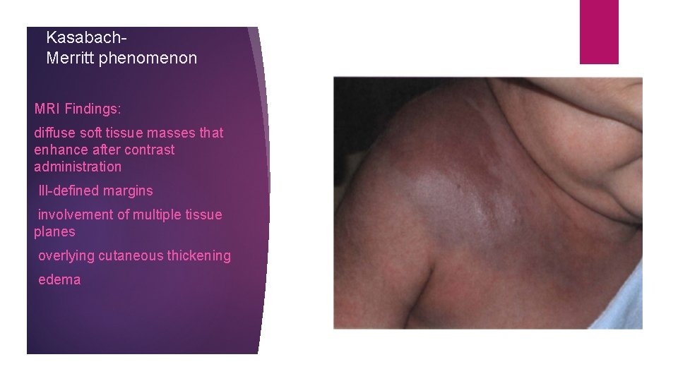 Kasabach. Merritt phenomenon MRI Findings: diffuse soft tissue masses that enhance after contrast administration