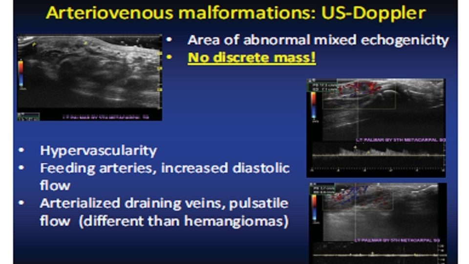 Arteriovenous malformation 