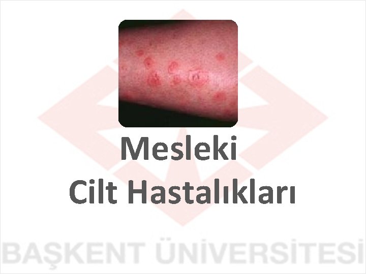 Mesleki Cilt Hastalıkları 